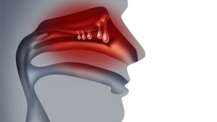 Illustration-of-nasal-polyps