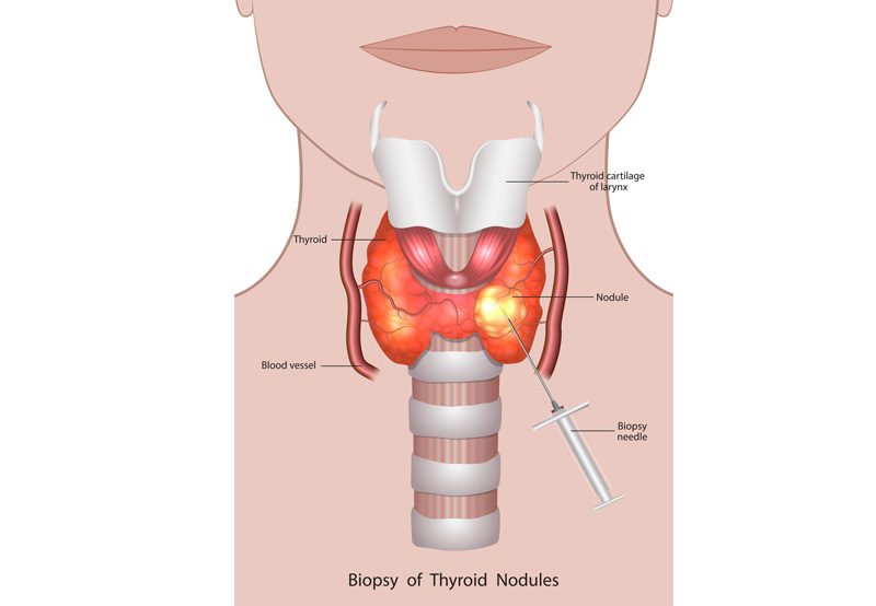 Illustration-of-thyroid-biopsy