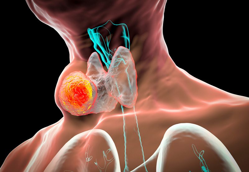 Illustration-of-thyroid-cancer-detected-through-thyroid-biopsy